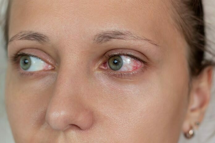 Allergies And Dry Eyes