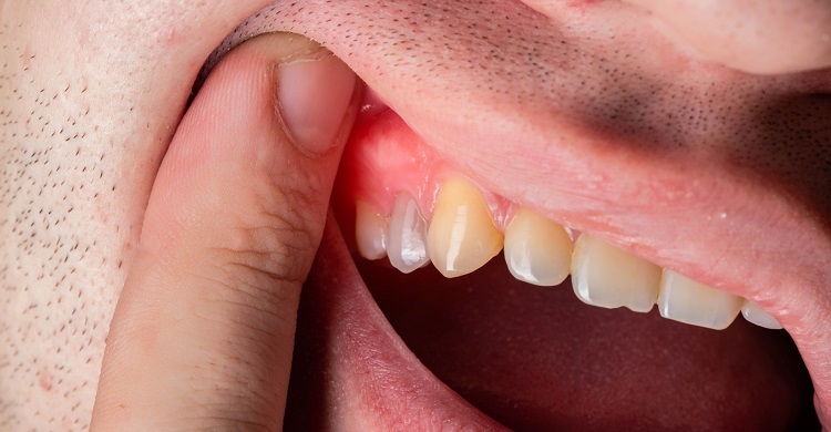 Dental Abscess